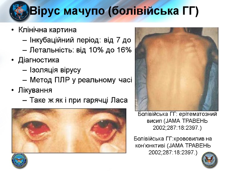 Вірус мачупо (болівійська ГГ) Клінічна картина Інкубаційний період: від 7 до 14 днів Летальність: